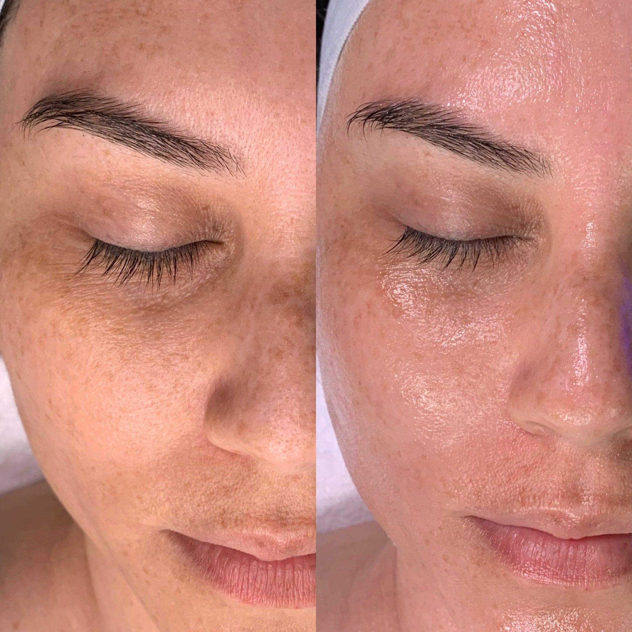 Deeply hydrated skin after Hydrafacial