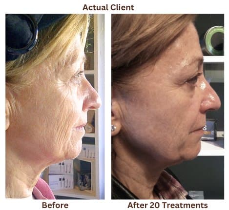 Microcurrent before and after result — client 1