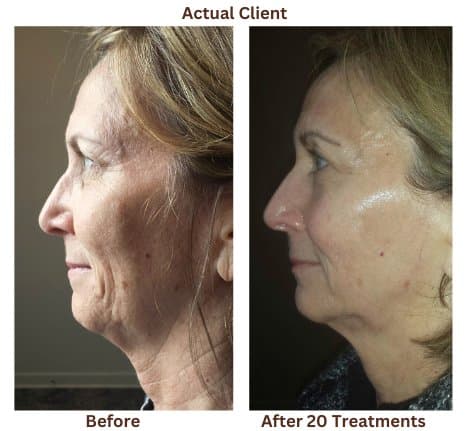 Microcurrent before and after result — client 2